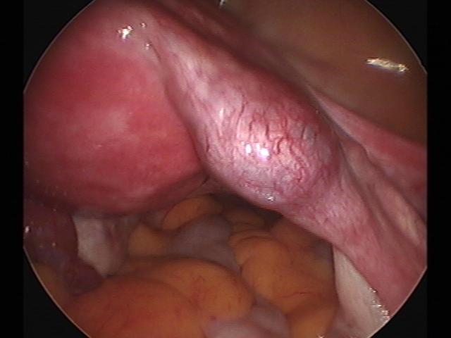 Ectopic (3)(2).jpg