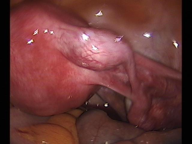 Ectopic(16).jpg