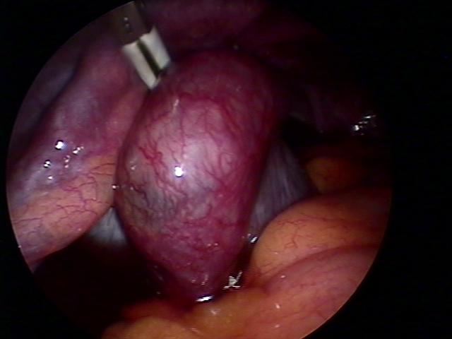 Ectopic(2).jpg