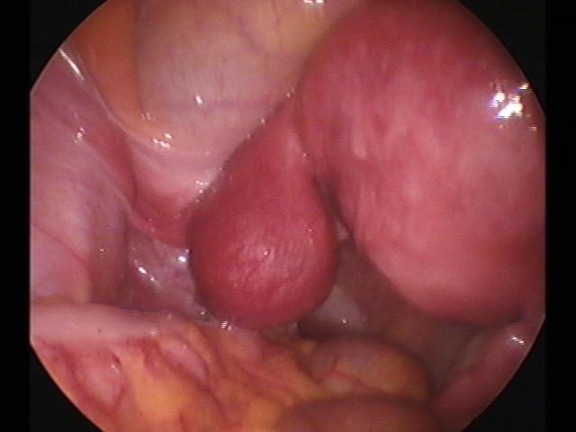 Ectopic(9).jpg