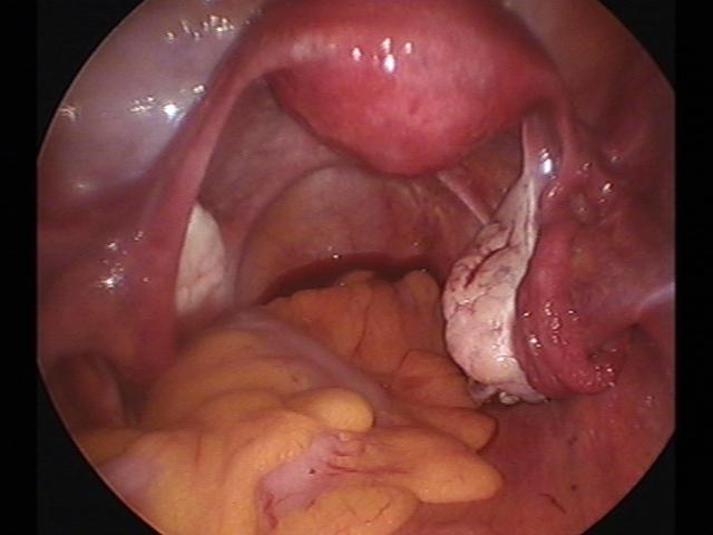 Ovary cystectomy (5).jpg