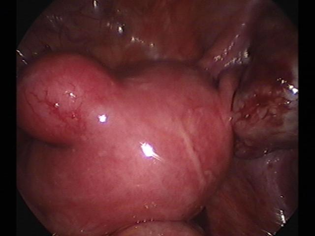 ROC&myomectomy (2).jpg