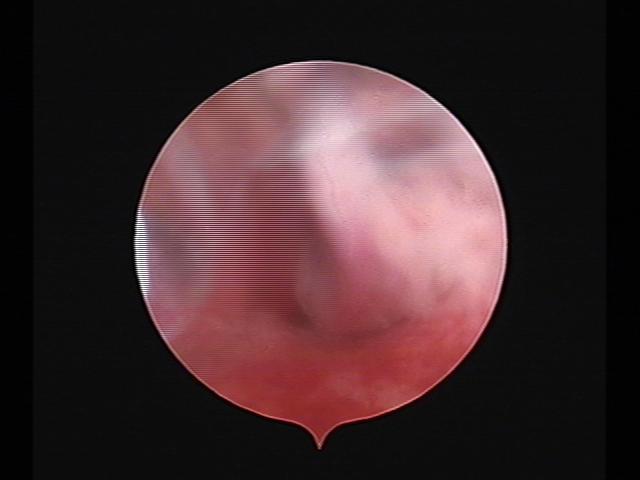 Resectoscopy (2)(33).jpg