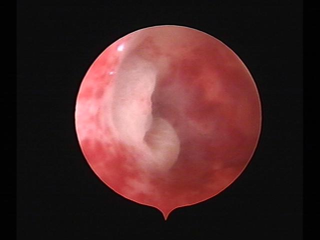 Resectoscopy (3)(24).jpg