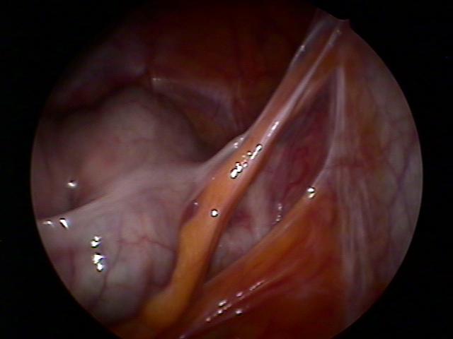 cystectomy (8).jpg