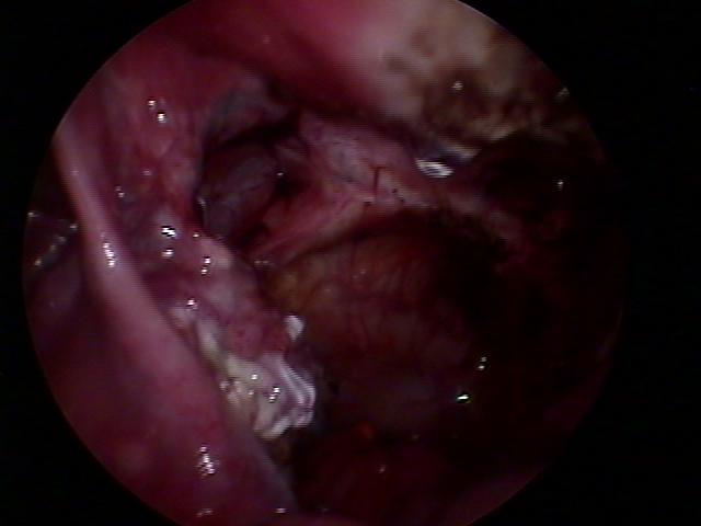 cystectomy&resectoscopy (12).jpg