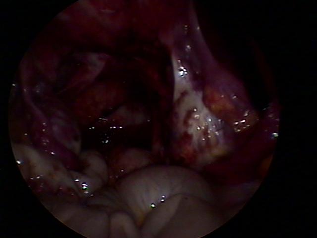 cystectomy&resectoscopy (3).jpg