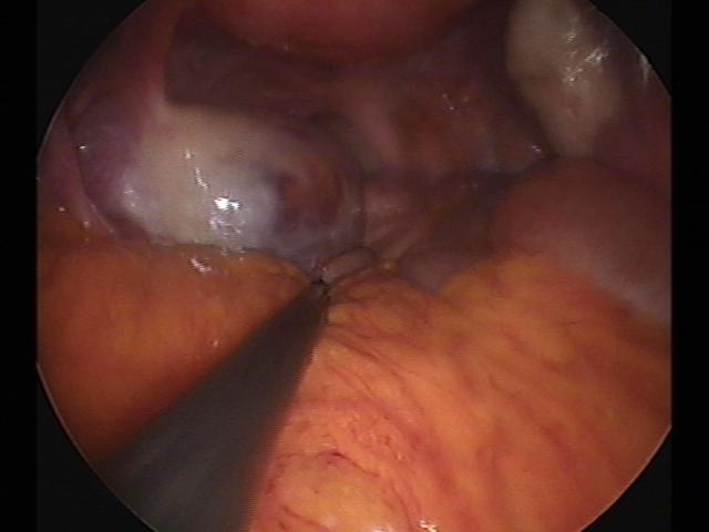 ectopic (4)(3).jpg