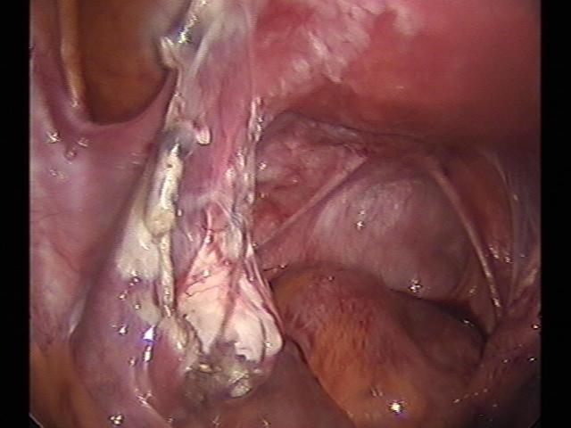 ectopic (5)(1).jpg