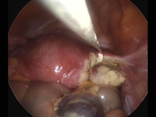 ectopic (5)(2).jpg