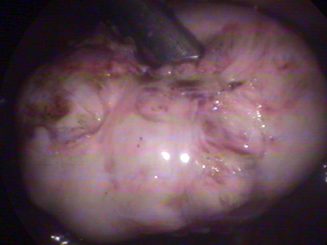 myomectomy (3)(0).jpg