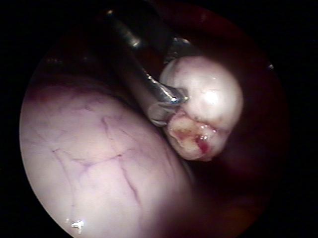 myomectomy (4)(1).jpg