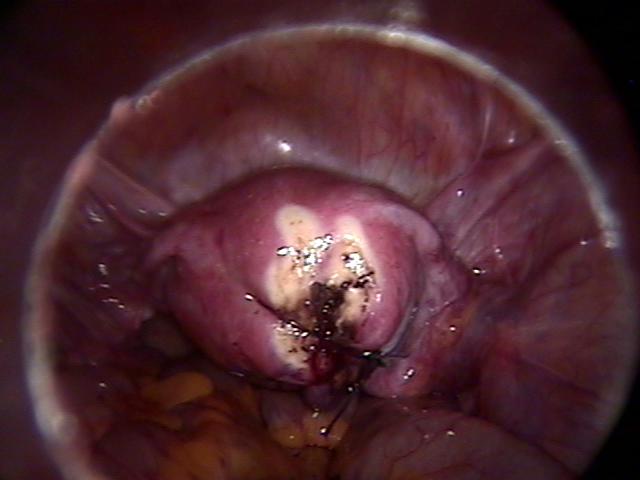 myomectomy (5).jpg