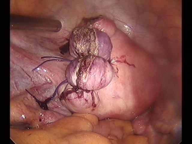 myomectomy (8).jpg