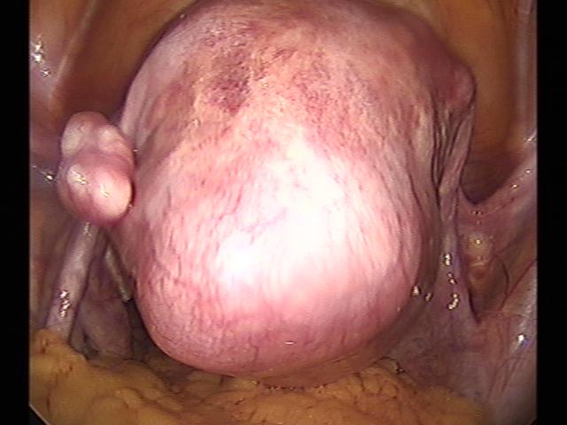 myomectomy(13).jpg