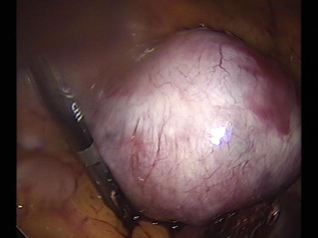 myomectomy(17).jpg