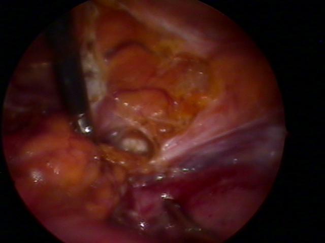 pelvic mass (6).jpg