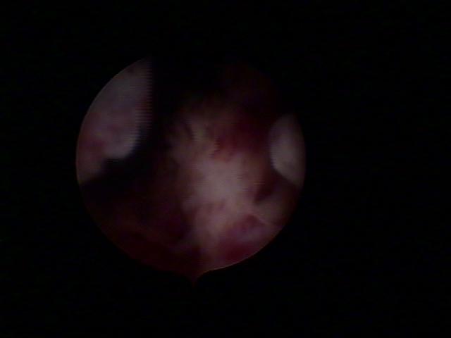 resectoscopy (2)(2).jpg