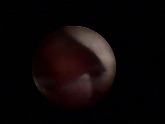 resectoscopy (3)(3).jpg